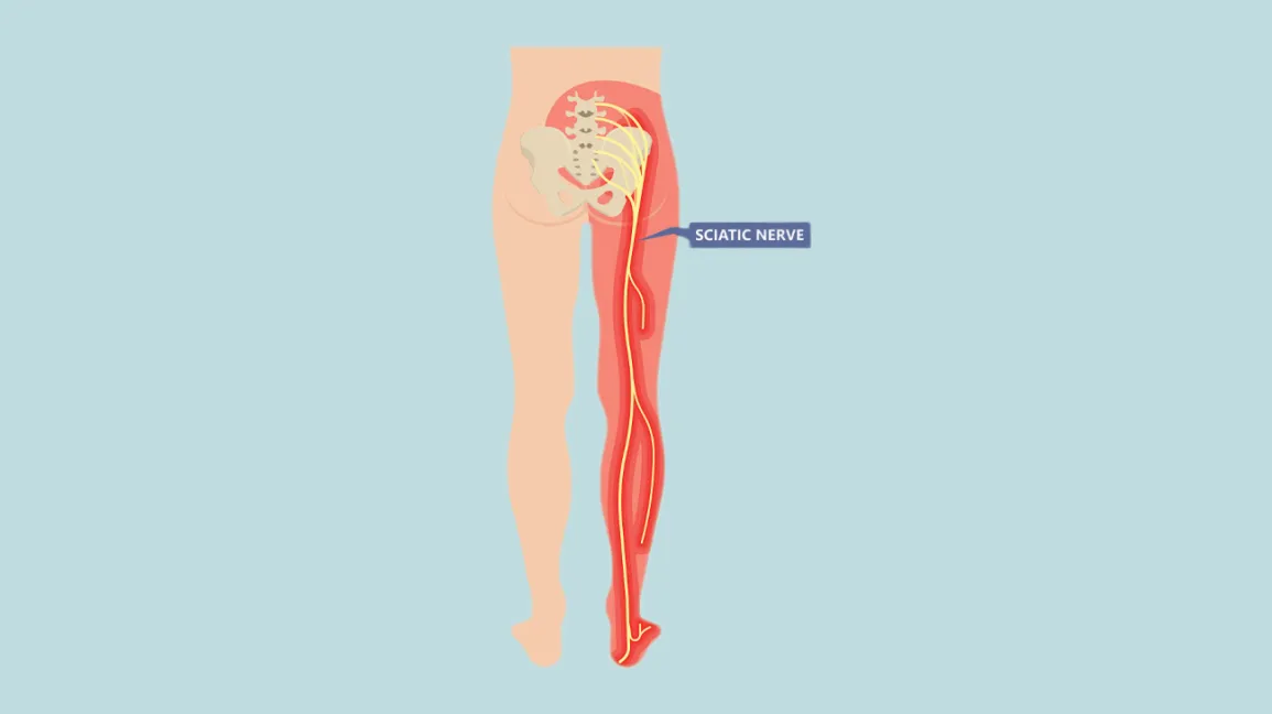 how long does sciatica last